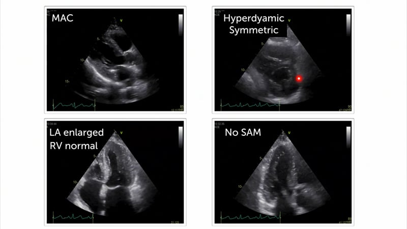 What is the reason for this patient's hypertrophy?