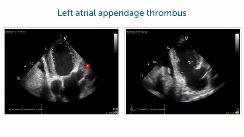 How can I image the LAA?