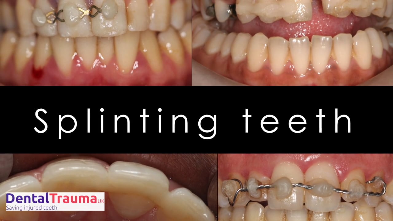 Splinting traumatised teeth on Vimeo