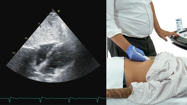 How can I image the IVC?
