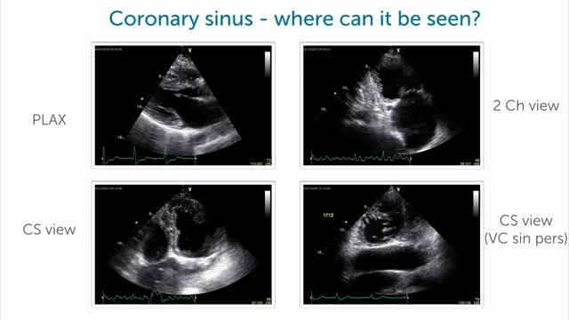 How can I image the coronary sinus?