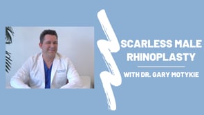 Scarless Male Rhinoplasty Procedure with Dr. Motykie