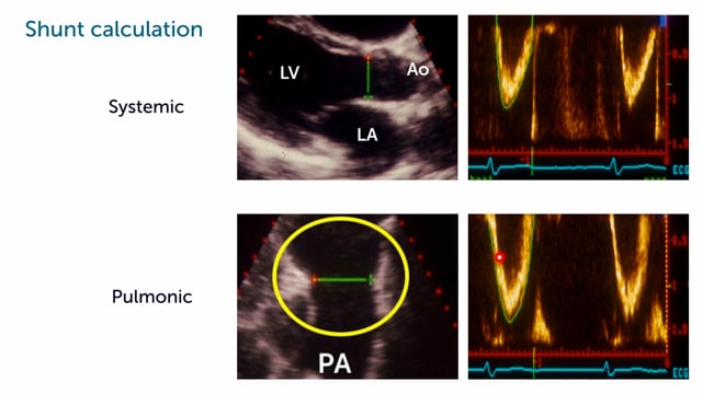 How to assess the Qp/Qs?