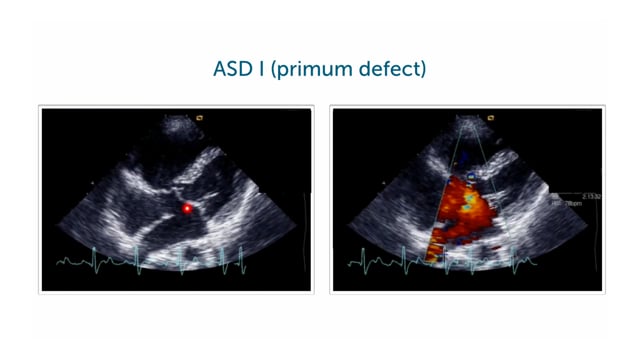 How to best image an atrial septal defect? Focus on ASD I