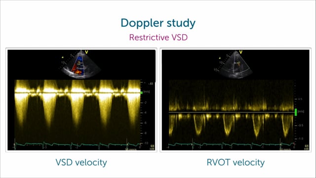 VSD or TR jet?