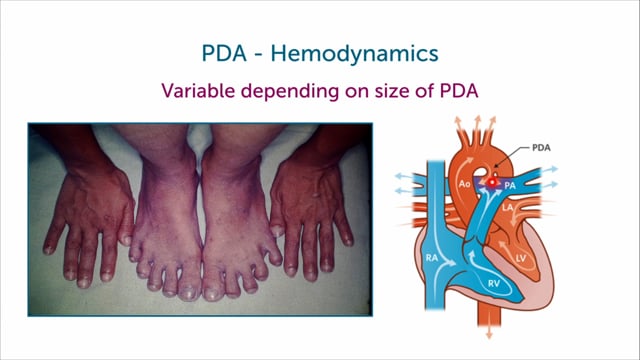 What happens if the ductus arteriosus does not close after birth?