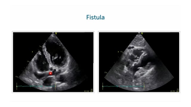 How to diagnose a coronary fistula by echo