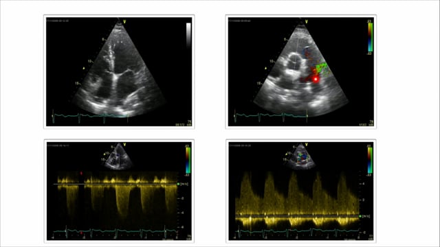 PDA and echo: how can I assess the pulmonary pressure?