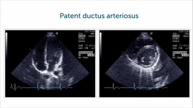 Tips for imaging atrial septum defects