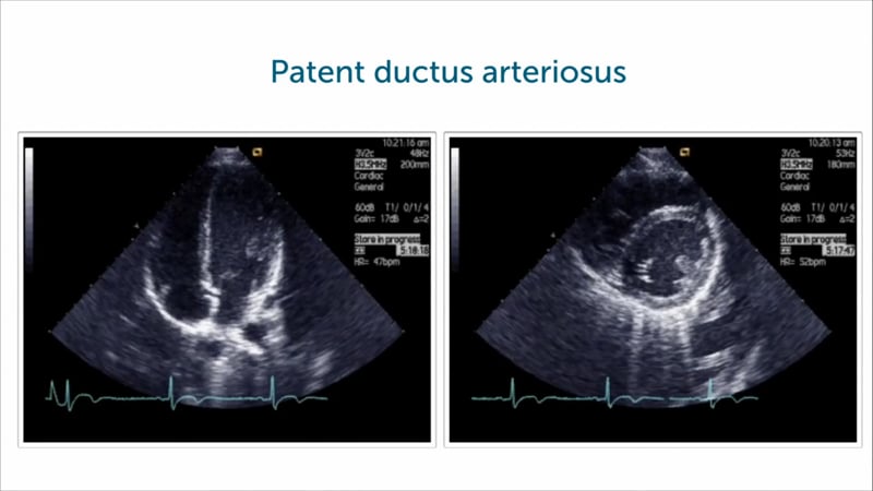 What's the cause of LV dilatation and dysfunction in this patient?