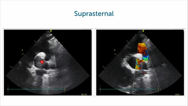 How to detect the PDA with TTE?