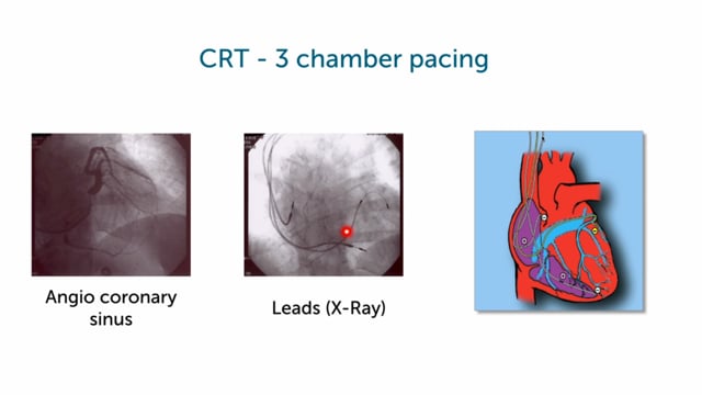 How does CRT work?