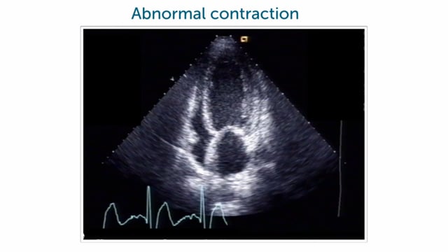 Speaking of cardiac contraction, what's dyssynchrony?