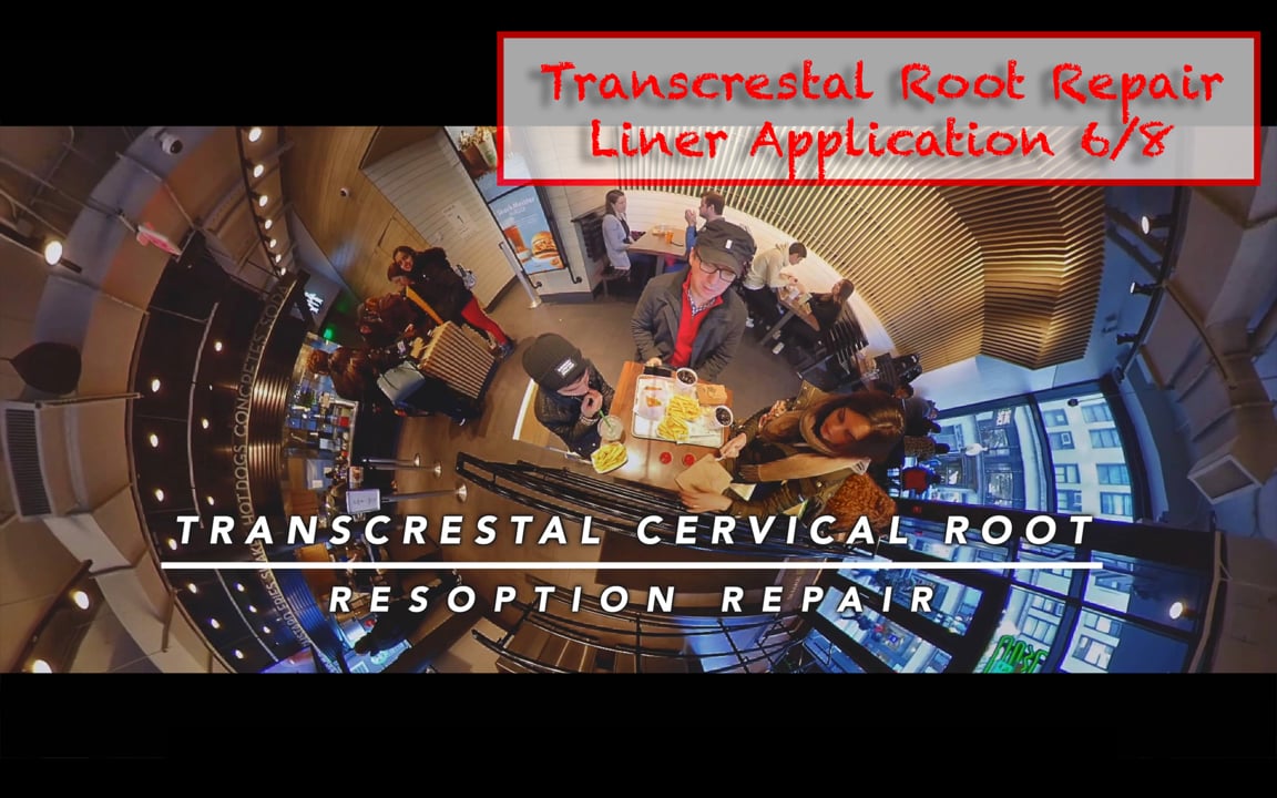 Transcrestal cervical root repair using BC Liner (Part 6 of 8) Real