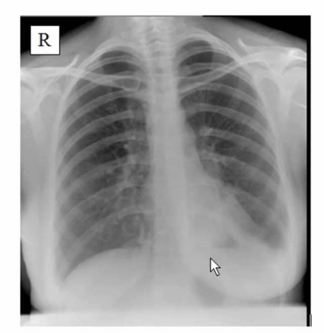 Pneumonia, Chest Xray, Pleural Effusion on Vimeo