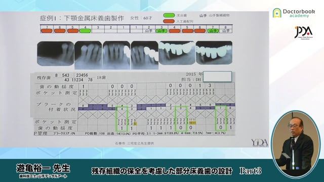 残存組織の保全を考慮した部分床義歯の設計 | Doctorbook