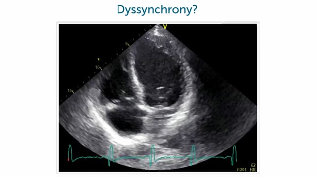 Are you able to detect dyssynchrony with the help of 2D echocardiography?