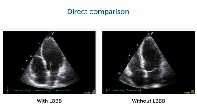 What's the impact of LBBB on LV function and LV ejection fraction?