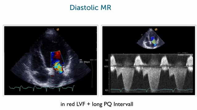 Presystolic mitral regurgitation: what is it and how shall we treat it?