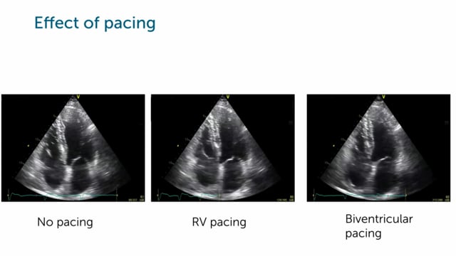 What's a common problem related to RV pacing? And what's the solution?