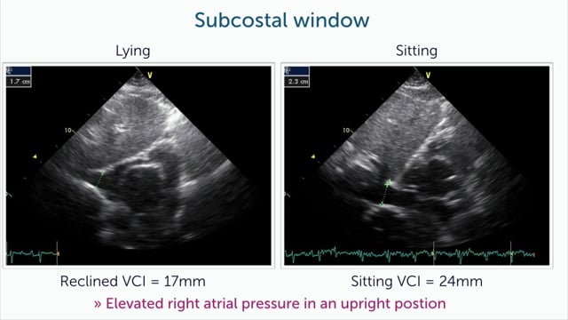 What's the cause of dyspnea? A patient with platypnea-orthodeoxia syndrome.