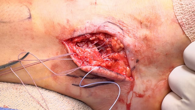 Sinus Tarsi Ganglion Cyst Excision and Broström-Gould Procedure for Chronic Ankle Instability