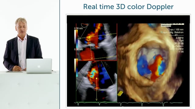 What is Real-Time 3D echocardiography?