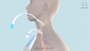 Open Tracheostomy - English