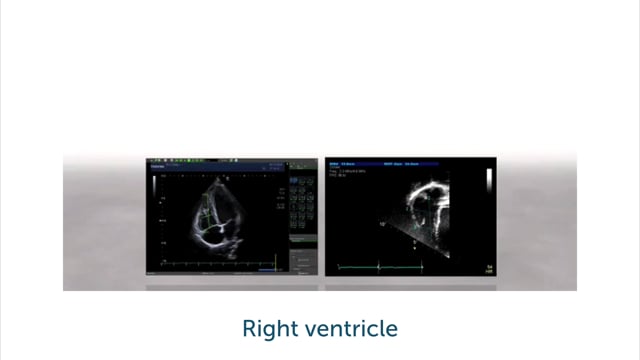 How can I assess the RV using 3D echocardiography?