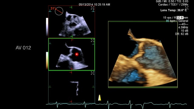 What does the AV look like in 3D echocardiography?