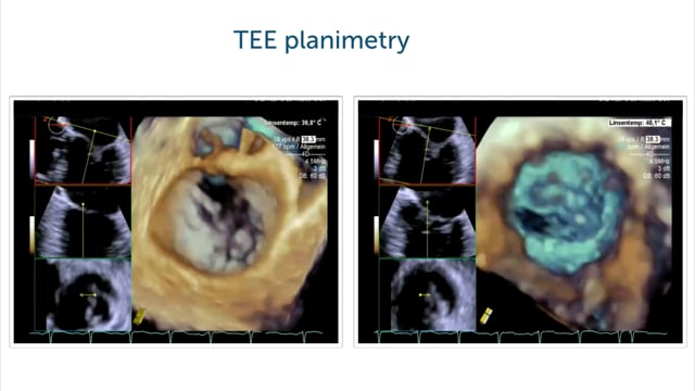 How can I assess mitral stenosis in 3D echocardiography?