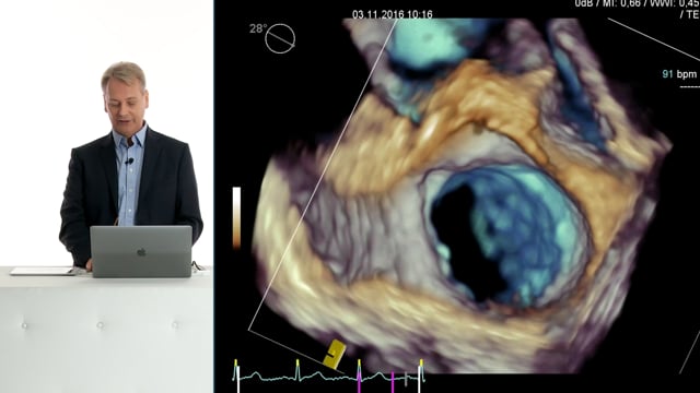 How can I find Mitral valve endocarditis using 3D echocardiography?