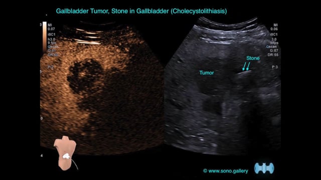 Gallbladder Tumor, Stone in Gallbladder (Cholecystolithiasis)