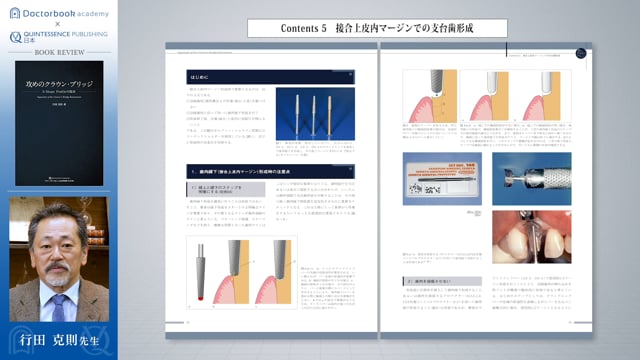 ＃2 接合上皮内マージンでの支台歯形成