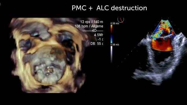 What are the benefits in MR assessment of 3D echocardiography?