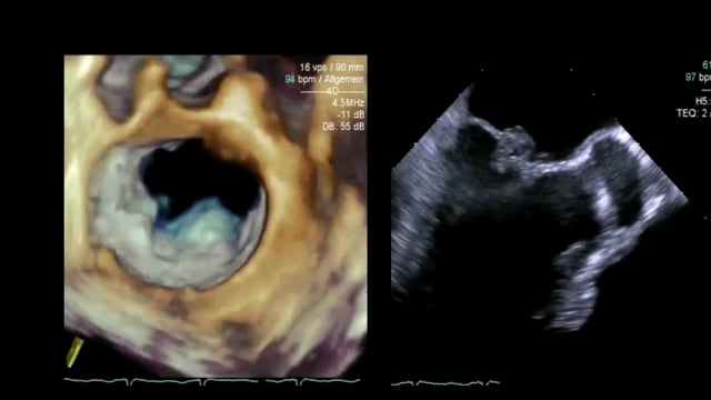 How would artifacts look in 3D echocardiography?