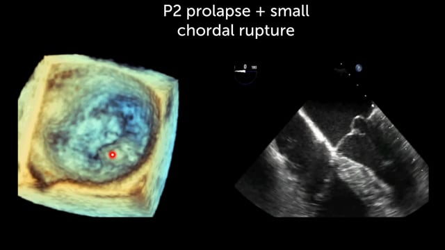 How can 3D echocardiography help in planning invasive procedures?