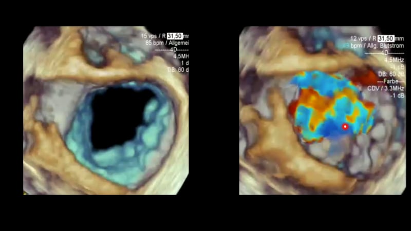 How can 3D echocardiography help displaying the Mitral valve's true shape?