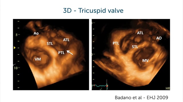 Should I use 3D echocardiography on the Tricuspid valve?