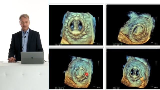 What is the value of 3D echocardiography when assessing prosthetic valves?