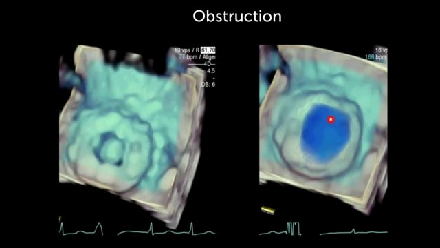 Can I use 3D echocardiography for assessing prosthetic valve obstruction?