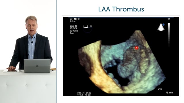 What value does 3D echocardiography have in assessing tumors and masses?