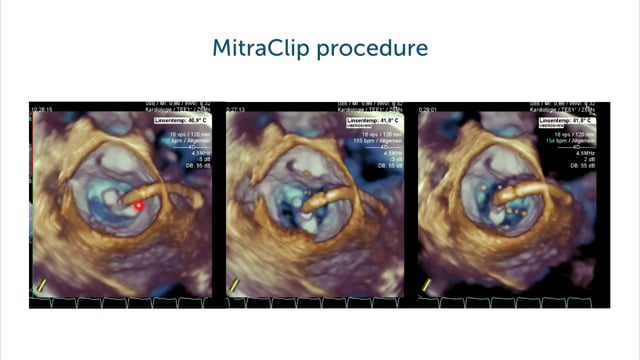 What is the role of 3D echocardiography in monitoring interventional procedures?