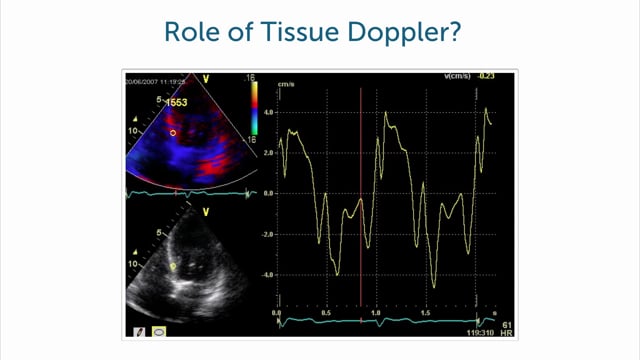 What is the value of tissue Doppler in the age of STE?