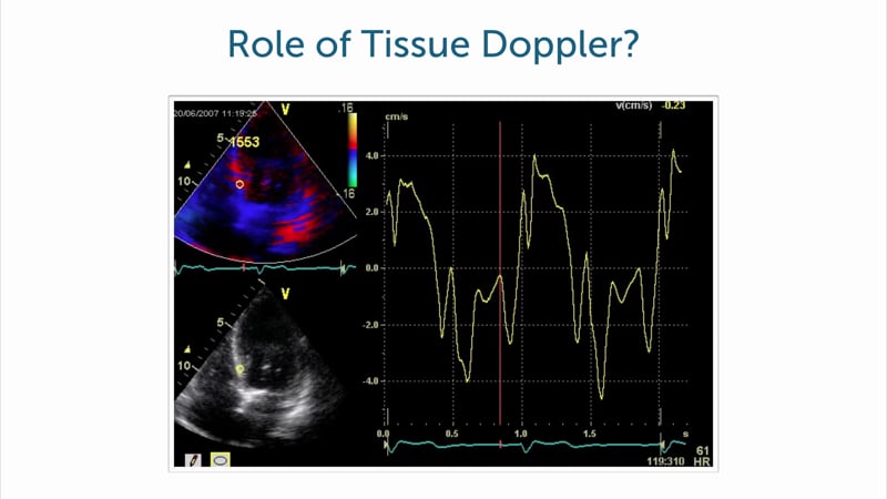 What is the value of tissue Doppler in the age of STE?