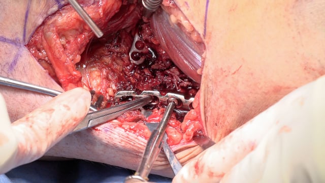 Posteromedial Technique for Management of Tricondylar Tibial Plateau Fractures