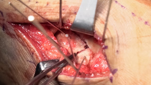 Surgical Management of Posterior Talus Process Fractures