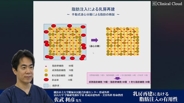 乳房再建における脂肪注入の有用性 -Part2-