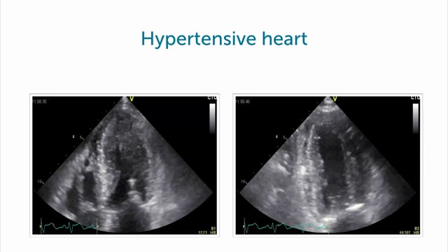 How does strain change with progressive hypertensive heart disease?