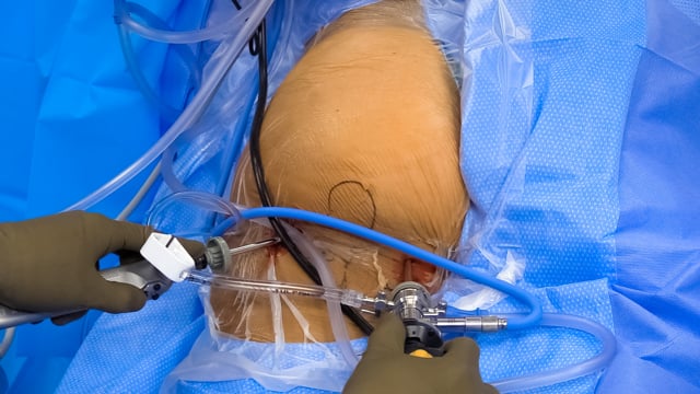 Endoscopic Partial Proximal Hamstring Repair